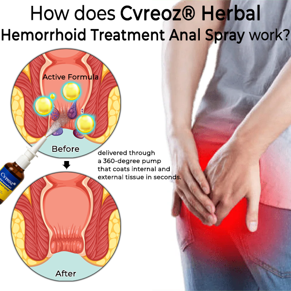 Herbal Hemorrhoid Treatment Anal Spray Pro